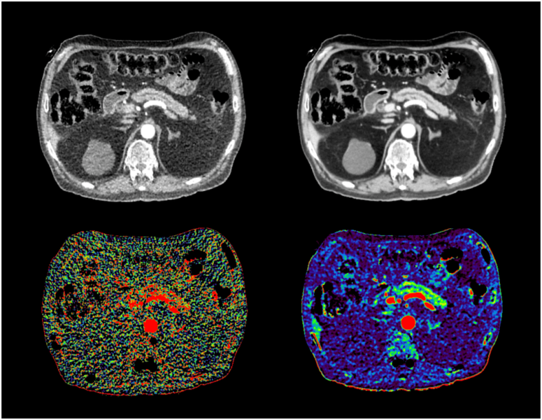 FILTER - Functional Imaging with Low dose cT pERfusion